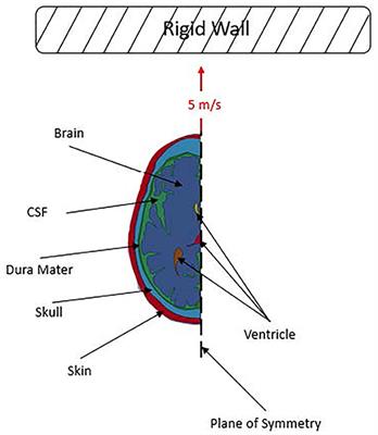 Simulation of the Strain Amplification in Sulci Due to Blunt Impact to the Head